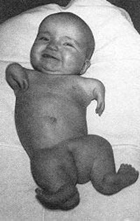 Thalidomide 3