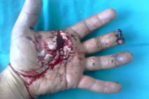 Hand injury from firecrackers